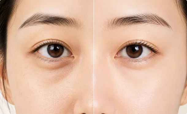 reduces-puffiness