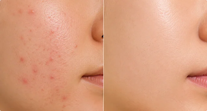 shields-blemishes